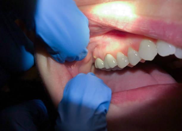 Best Emergency Dental Care for Sports Injuries in Freemansburg, PA